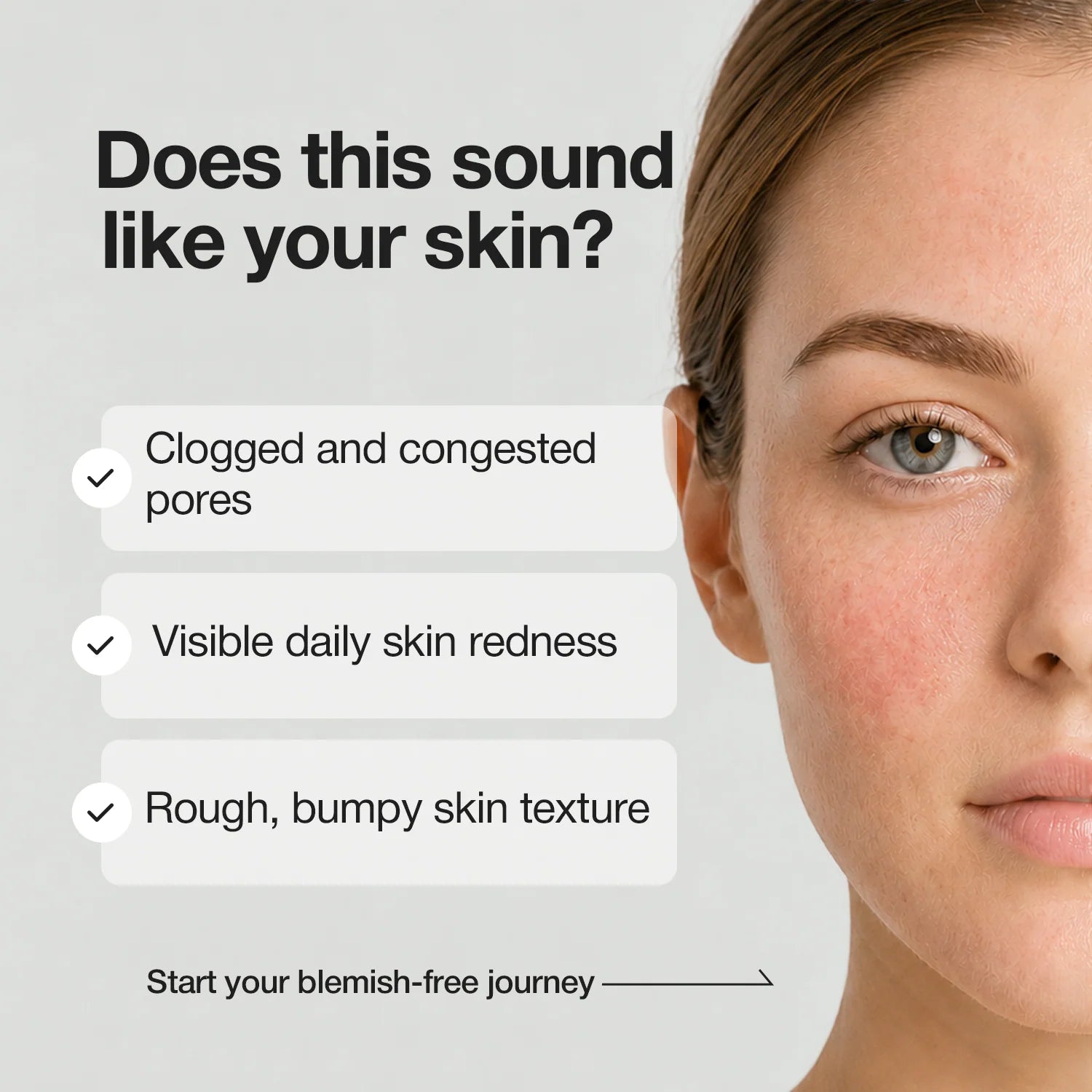 A-Control Azelaic Acid Toner - 150ml