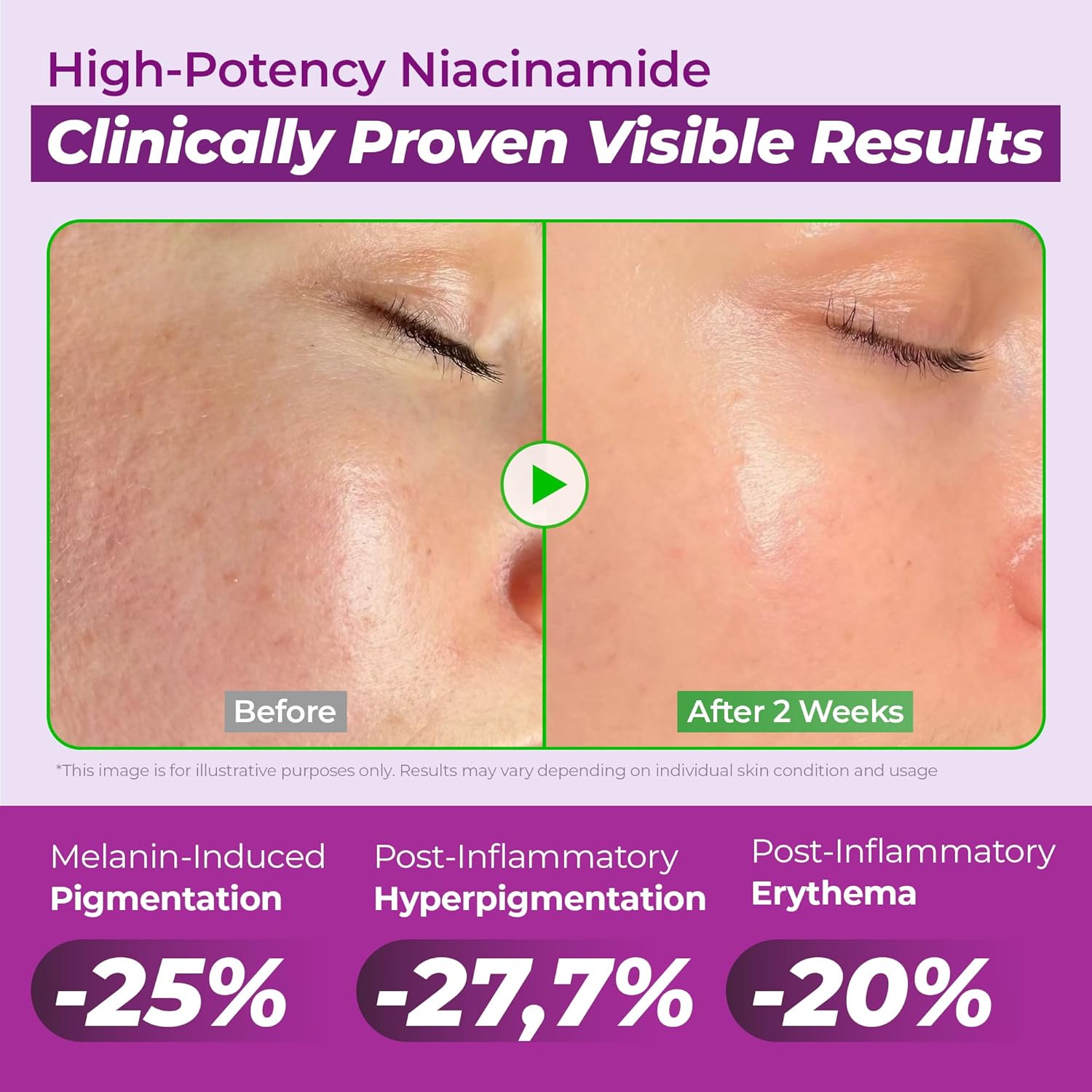 Infographic showing Niacinamide and Glutathione for acne scars and melasma