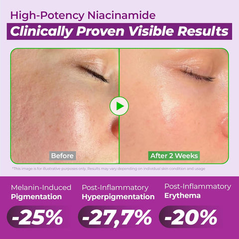 Infographic showing Niacinamide and Glutathione for acne scars and melasma