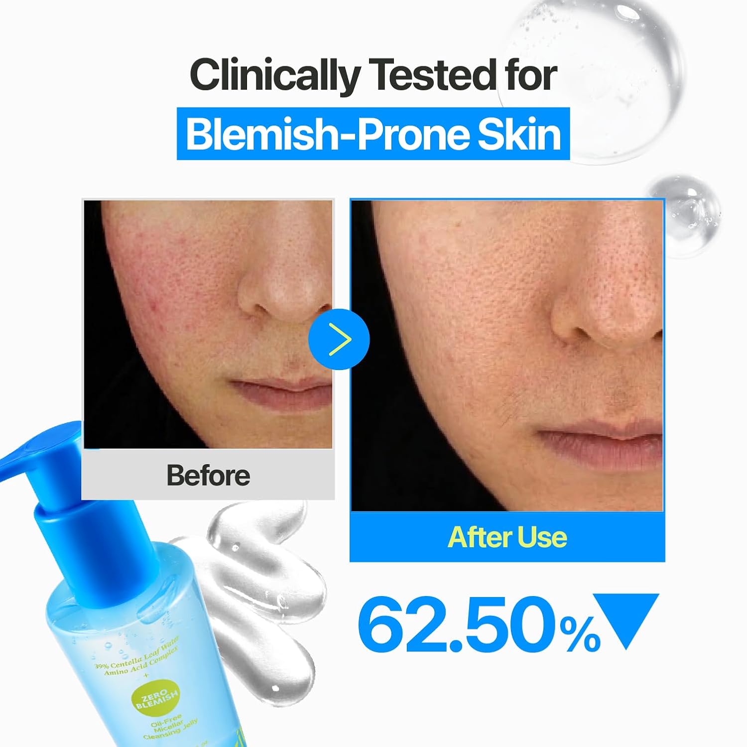 Zero Blemish Oil-Free Micellar Cleansing Jelly - 200ml