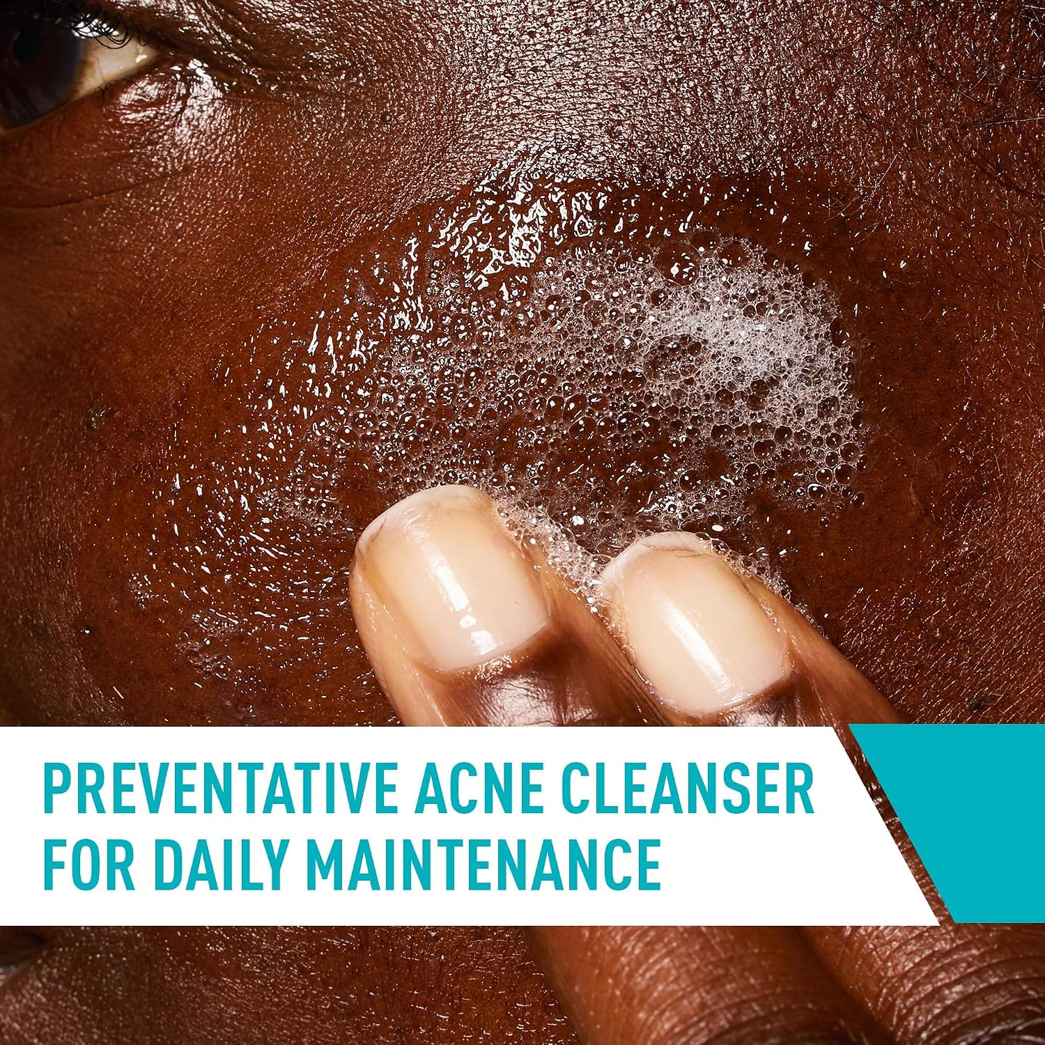 Acne Control Cleanser - 237ml