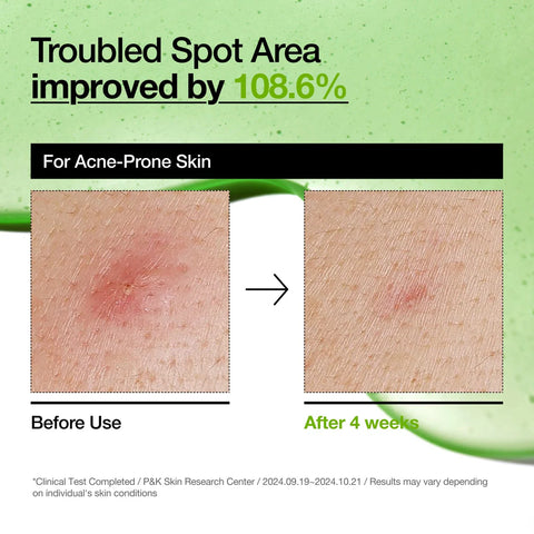 Azelaic Acid 10 Hyaluron Redness Soothing Serum - 30ml