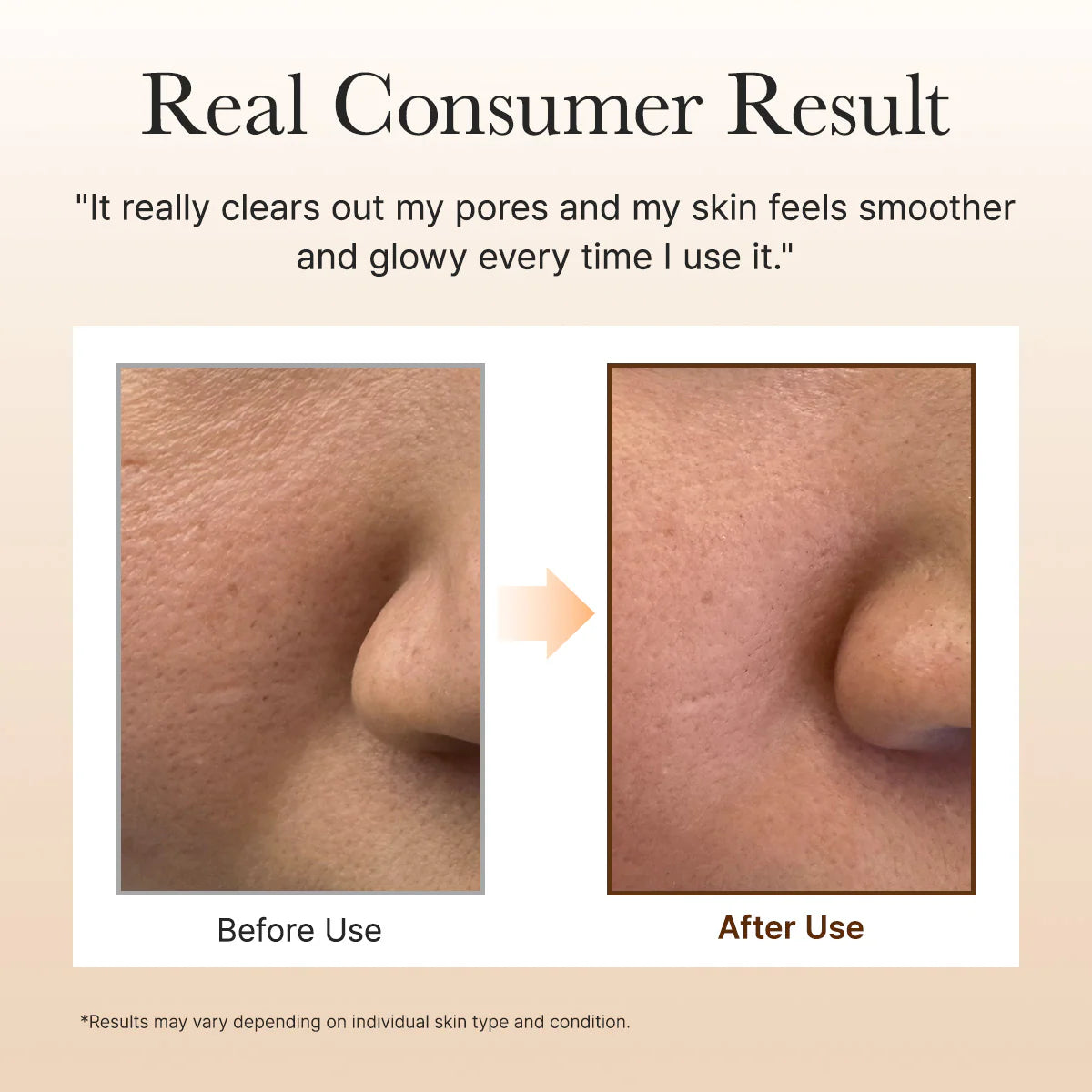 Before and after skin pore clearing treatment on a beige background with text.