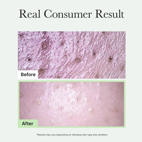 Before and after comparison of skin texture on a light gray background with text 'Real Consumer Result'.