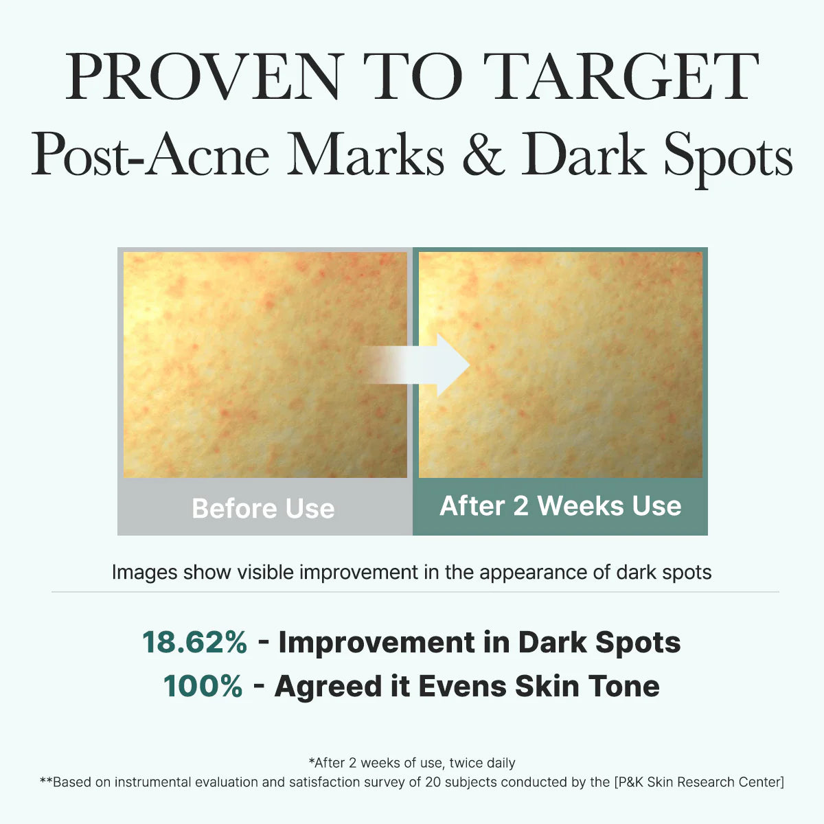 Before and after comparison of post-acne marks and dark spots with text indicating proven effectiveness.