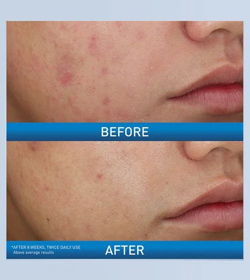 Acne Foaming Cream Wash - 150ml