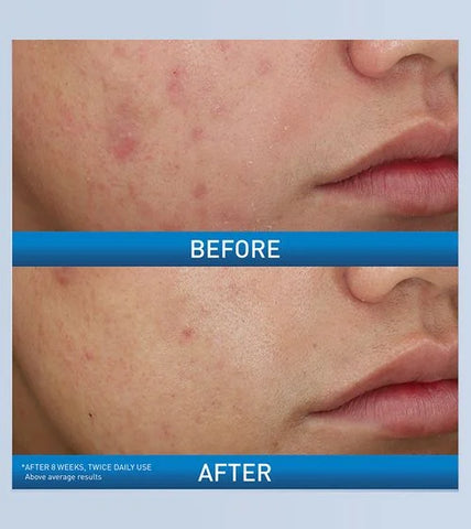 Acne Foaming Cream Wash - 150ml