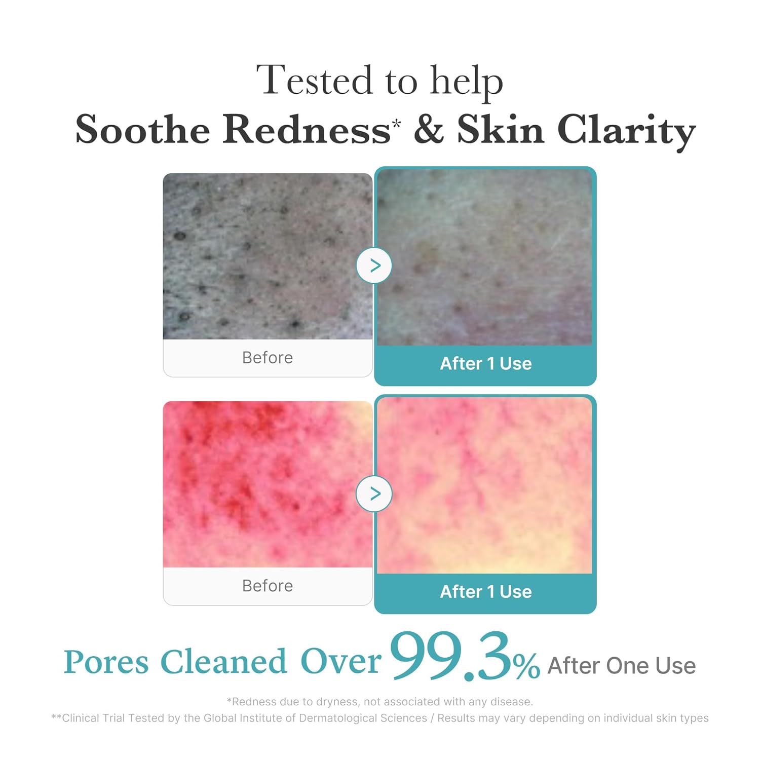Before and after effects of a Medicue skincare product on skin texture and redness.