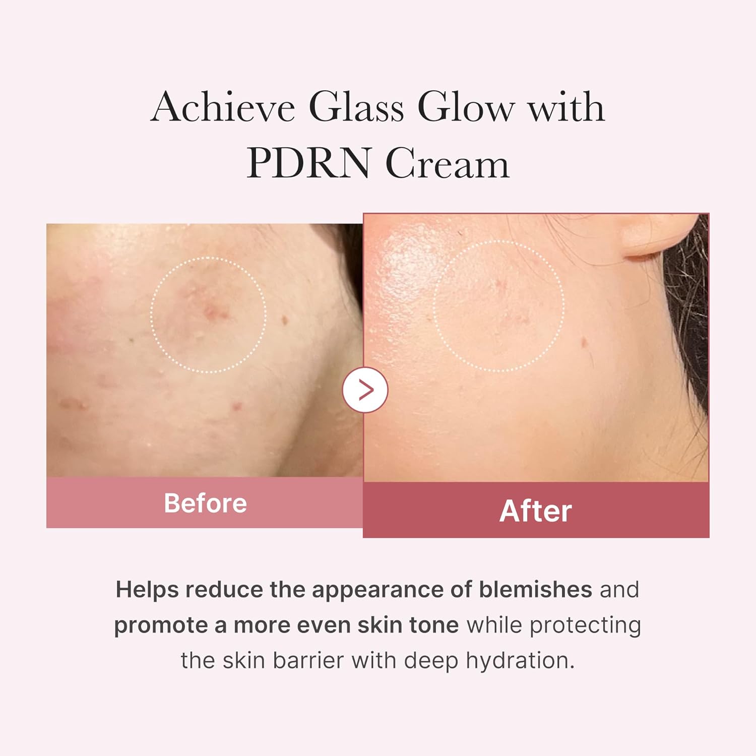 Before and after comparison of PDRN Cream on skin with text highlighting benefits.