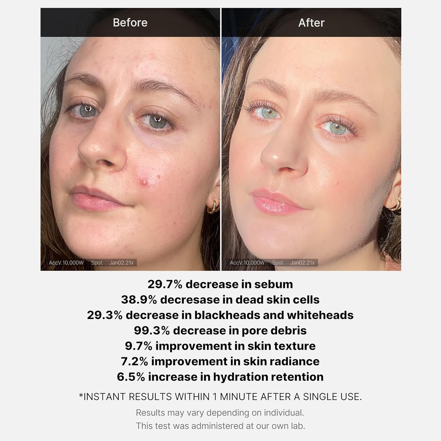 Red Acne Succinic Acid Peel - 40g