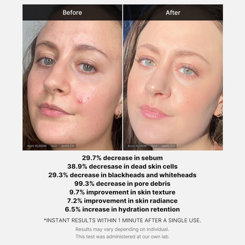 Red Acne Succinic Acid Peel - 40g