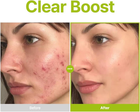 Azelaic Acid 10 Kojic Tea Tree Serum - 30ml